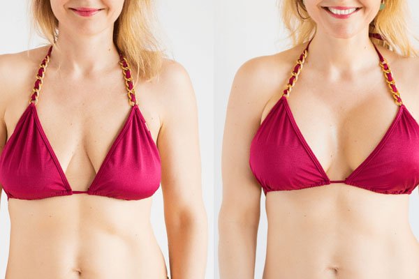 best breast augmentation in East Delhi