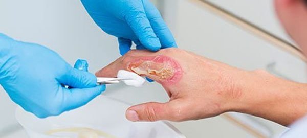 Burns treatment in Delhi