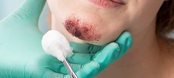 facial trauma