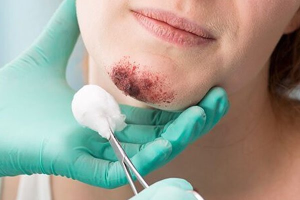 facial trauma