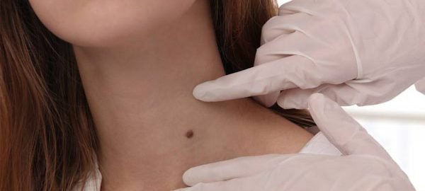 Moles-Removal-in-Delhi