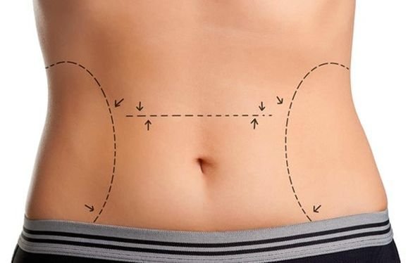 best abdominoplasty in Panipat