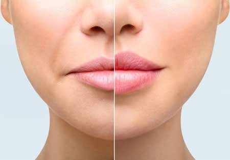 lip reshaping in Delhi