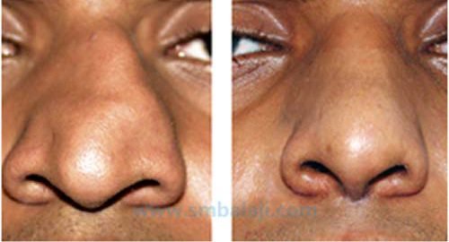 Nose-reshaping