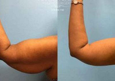 arm-lift