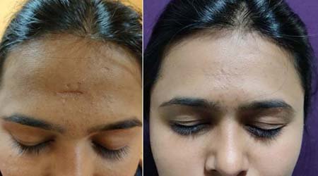 scar treatment in East Delhi