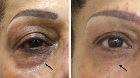 Blepharoplasty