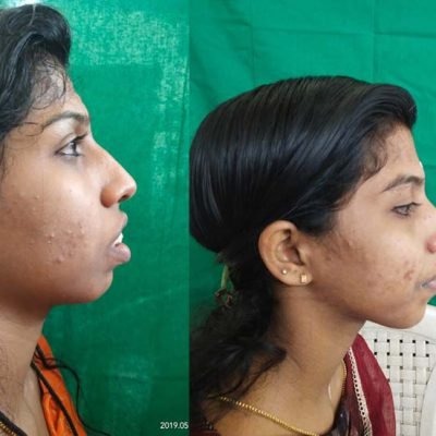 chin-reshaping-1