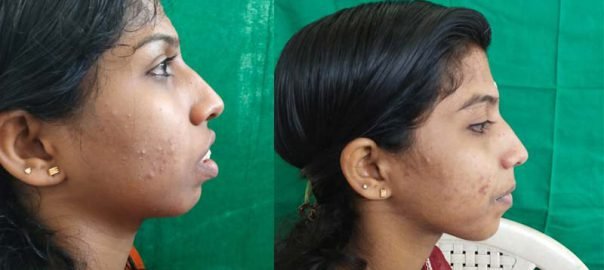 chin-reshaping-1