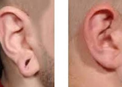 ear-lobuloplasty