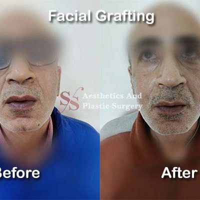 facial-grafting