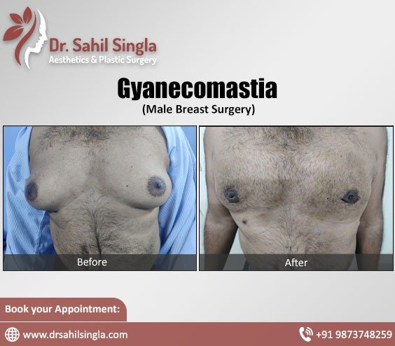 Male Breast Reduction Surgery in East Delhi