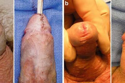 hypospadias