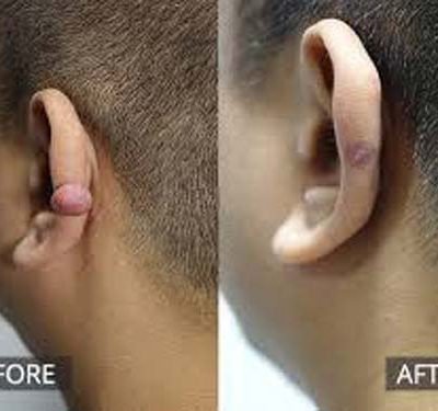 keloid-ear-2