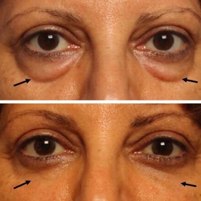 lower-eyelid-blepharoplasty