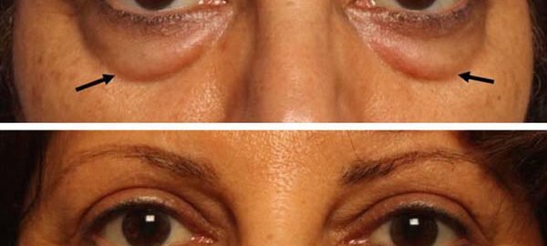 lower-eyelid-blepharoplasty