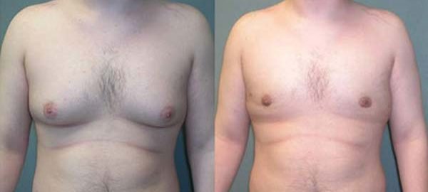 male-breast-reduction