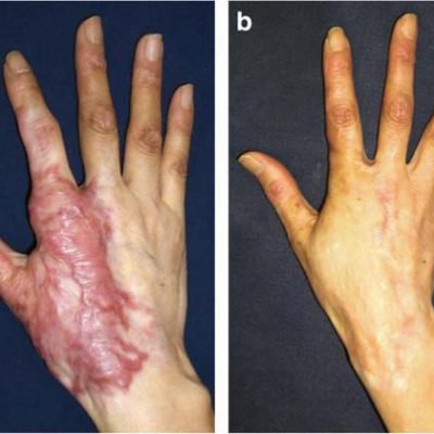 post-burn-scarring-hand