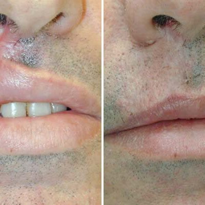 scar treatment in delhi