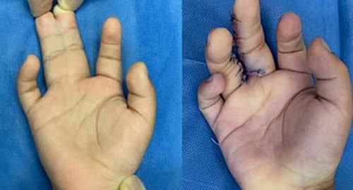 syndactyly-hand