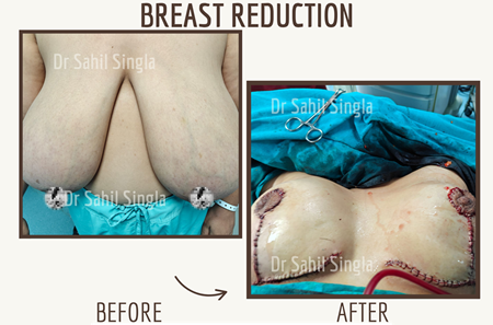 Breast Reduction