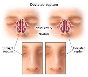 deviated septum